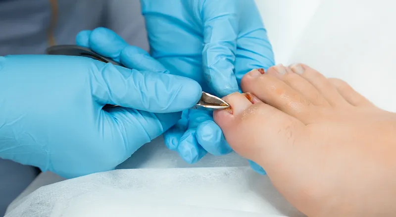 Doctor tratando uña del pie